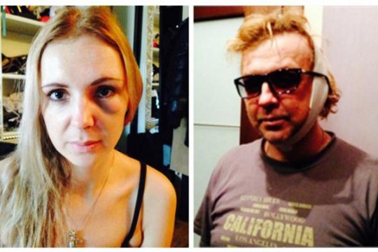 Певцу Роме Жукову пришлось сделать пластическую операцию.