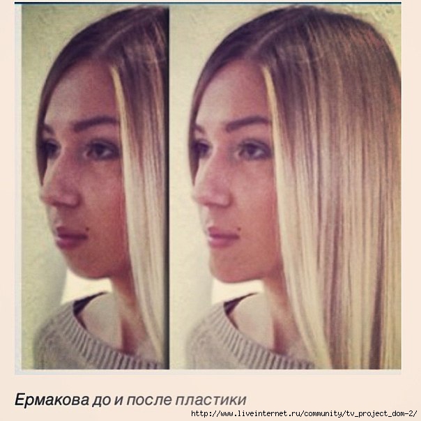 Надя Ермакова до и после пластики