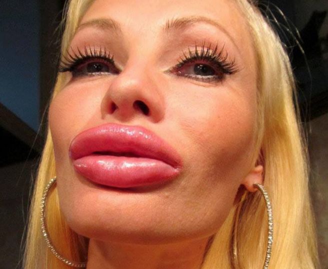 «Без пухлых губ — это как без макияжа!» Белоруски показывают фото до и после уколов красоты
