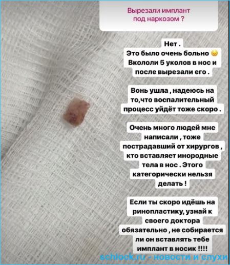 Настя Балинская призывает не делать пластические операции, став "жертвой красоты"