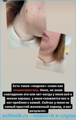 В сети нашли общие проблемы с кожей у Черно и Савкиной