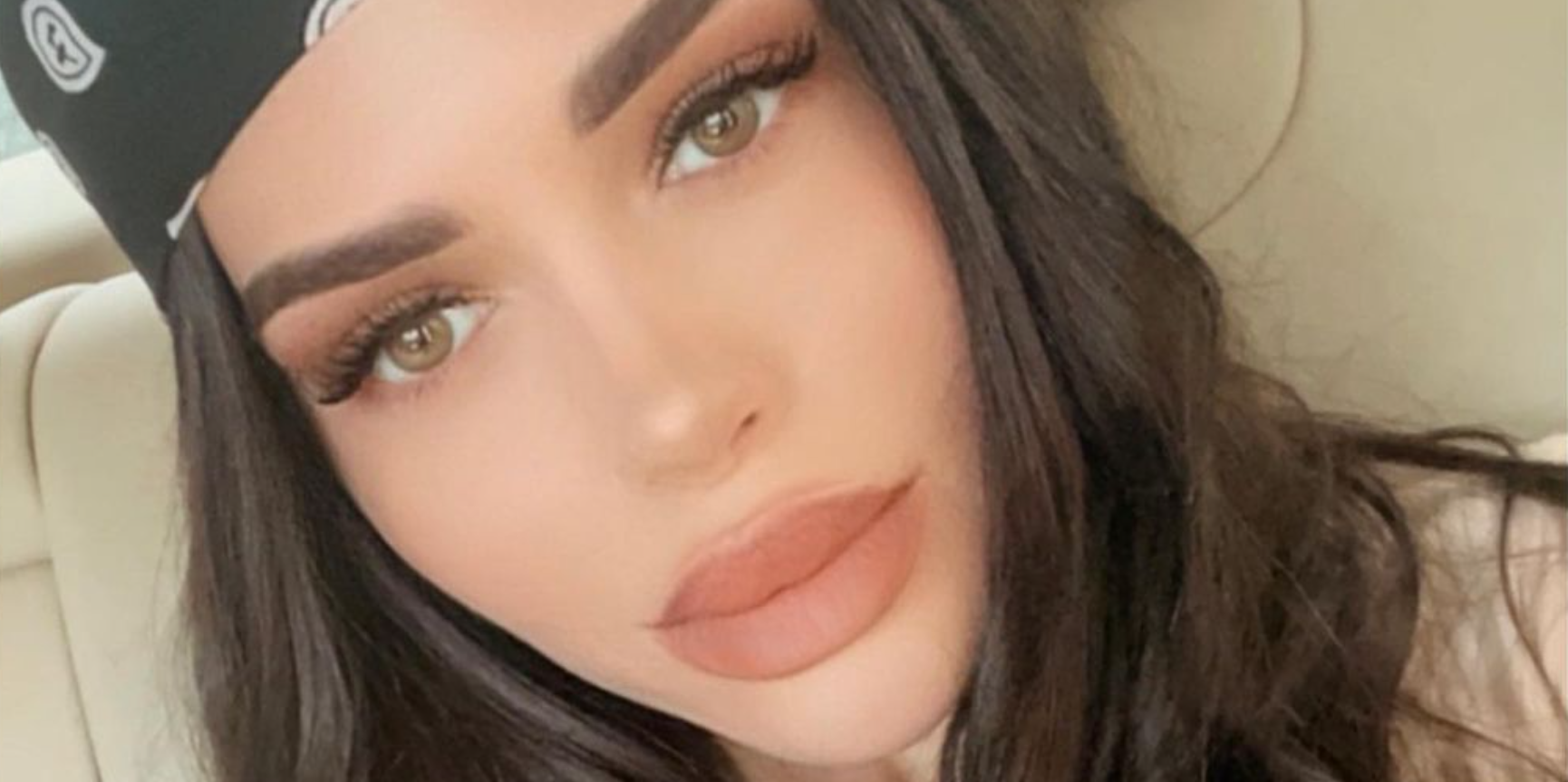 Анастасии Балинской сделали четвертую ринопластику и собрали по кусочкам нос Анастасии Балинской сделали четвертую ринопластику и собрали по кусочкам нос