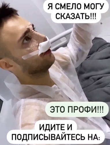 Алексей Безус сделал ринопластику