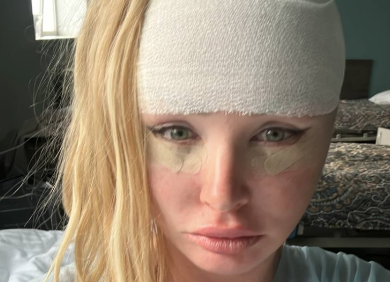 Дарья Пынзарь сделала лифтинг лица и блефаропластику