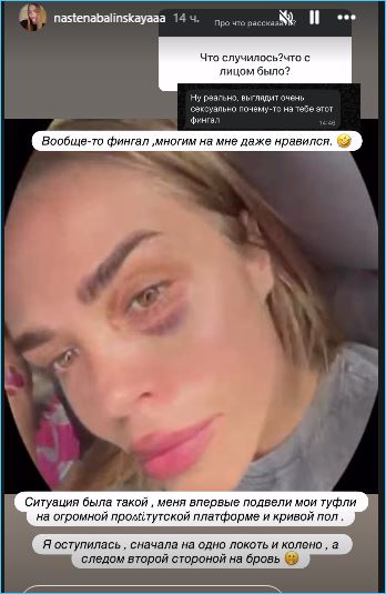 Анастасия Балинская рассказала, как она неудачно упала