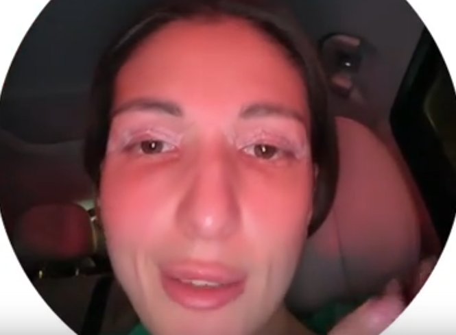 Яна Захарова сделала блефаропластику Яна Захарова сделала блефаропластику