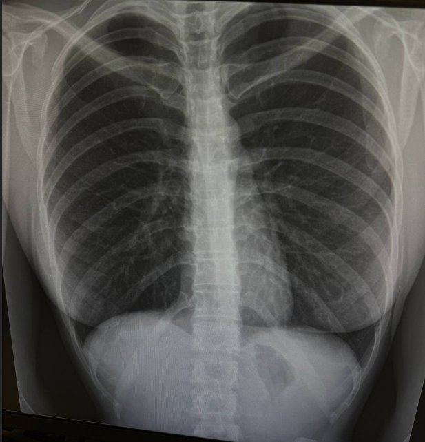 Яна Захарова сделала блефаропластику