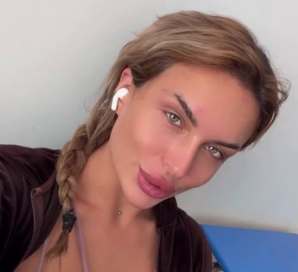 Виктория Дилье сделала ринопластику