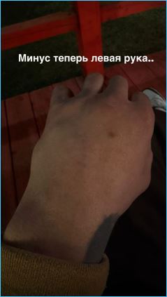 Владимир Балан опять получил травму