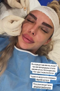 25-летняя Виктория Дилье сделала подтяжку лица